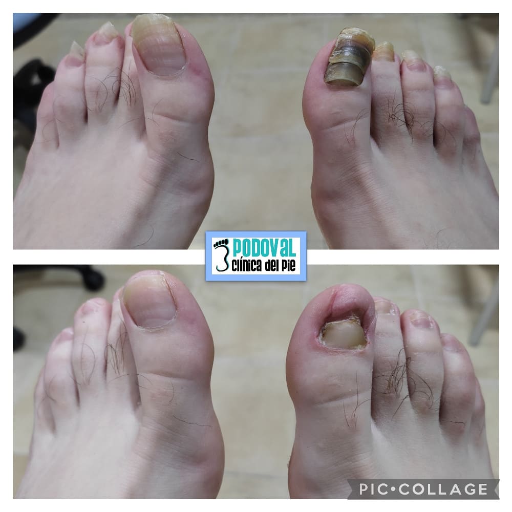 Chiropody – Effective Solution for Thick and Painful Nails